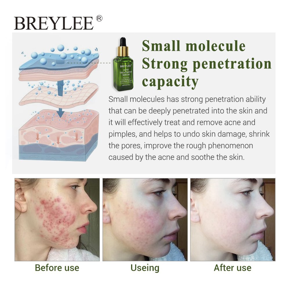 BREYLEE Acne Treatment Serum Face Facial Anti Acne Scar Removal Cream Skin Care Whitening Repair Pimple Remover For Acne - Glamour Gale Acne Treatment
