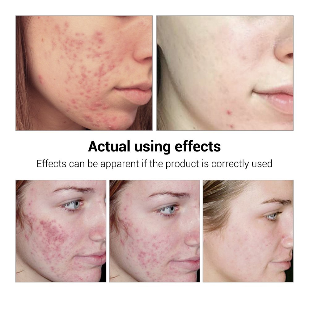 BREYLEE Acne Treatment Serum Face Facial Anti Acne Scar Removal Cream Skin Care Whitening Repair Pimple Remover For Acne - Glamour Gale Acne Treatment