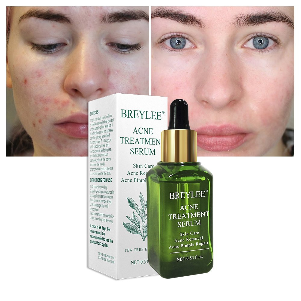 BREYLEE Acne Treatment Serum Face Facial Anti Acne Scar Removal Cream Skin Care Whitening Repair Pimple Remover For Acne - Glamour Gale Acne Treatment