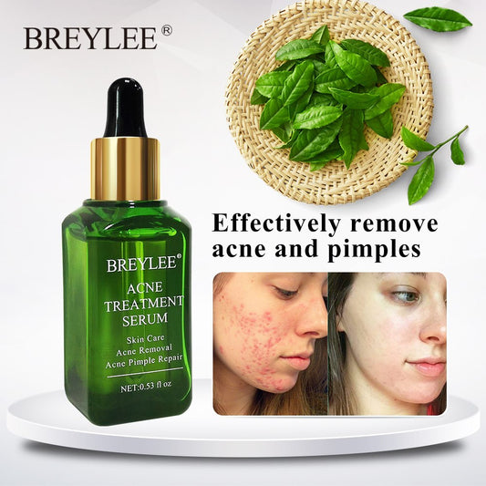 BREYLEE Acne Treatment Serum Face Facial Anti Acne Scar Removal Cream Skin Care Whitening Repair Pimple Remover For Acne - Glamour Gale Acne Treatment