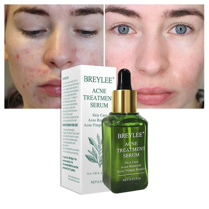 BREYLEE Acne Treatment Serum Face Facial Anti Acne Scar Removal Cream Skin Care Whitening Repair Pimple Remover For Acne - Glamour Gale Acne Treatment